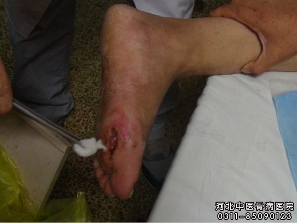 我院骨髓炎患者正在换药