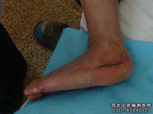 硬化性骨髓炎患者的伤口部位