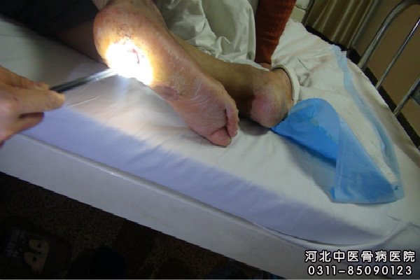 我院跟骨骨髓炎患者正在进行换药处理