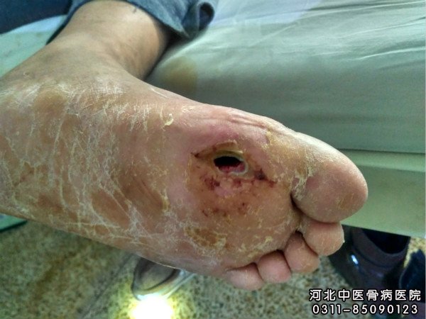 我院骨髓炎足部患者的患处部位