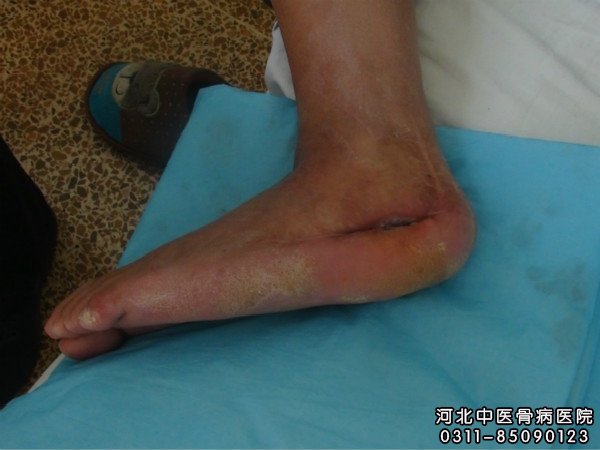 我院骨髓炎住院患者的病情
