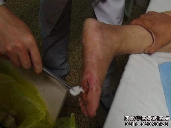我院中医骨科大夫在为骨髓炎足部患者清理伤口