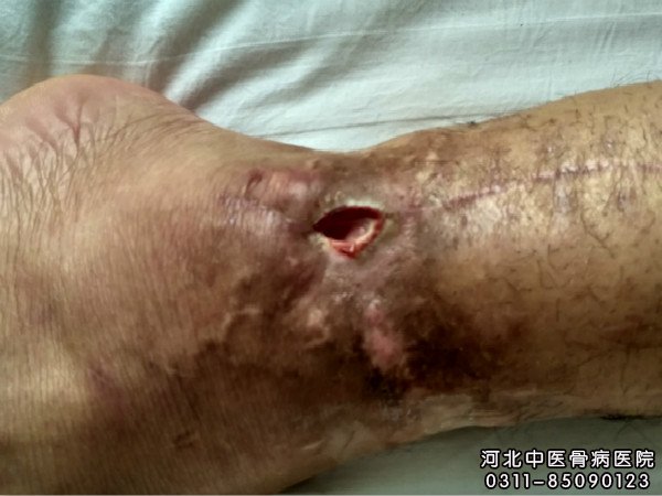 我院中医骨科住院患者的伤口部位