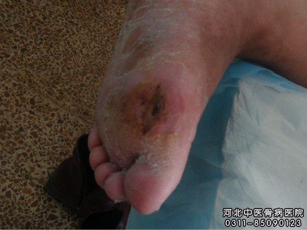 骨髓炎患者的伤口部位