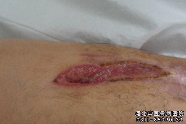骨髓炎患者的伤口部位