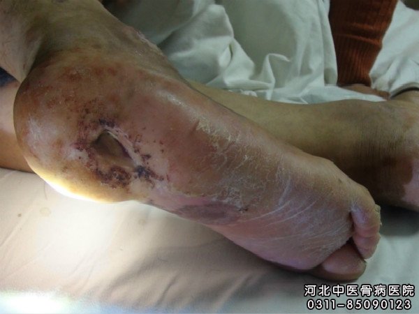 我院骨髓炎住院患者的伤口部位