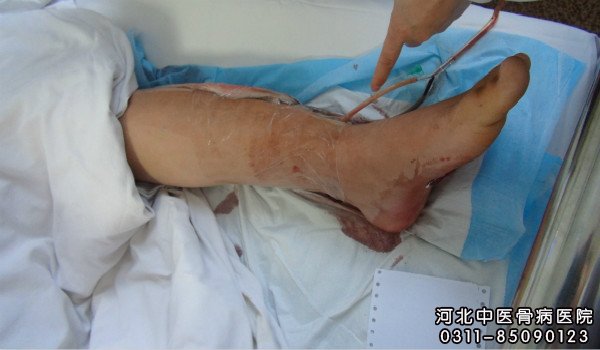 骨髓炎患者的伤口部位