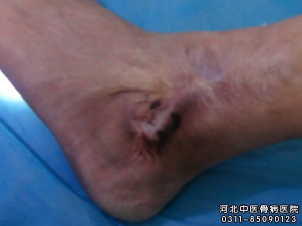我院骨髓炎患者的伤口部位