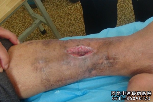 我院骨髓炎住院患者的患处