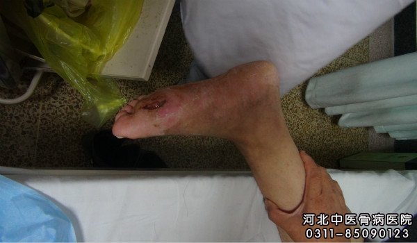 我院骨髓炎患者的伤口部位