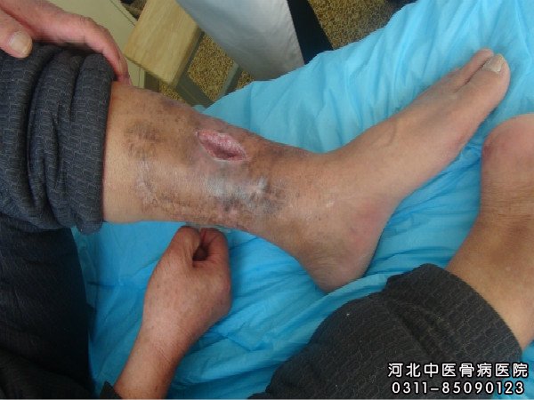 骨髓炎患者的伤口部位
