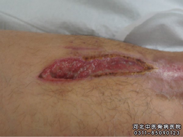 骨髓炎患者伤口