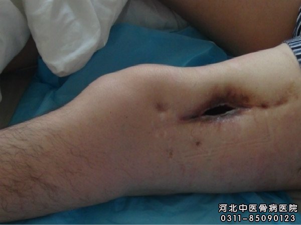 骨髓炎患者的伤口