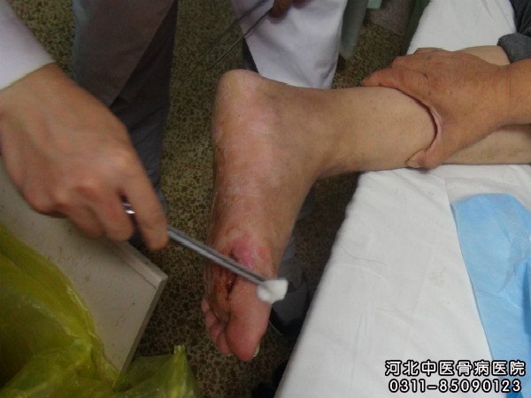 骨髓炎患者的伤口部位