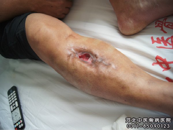 骨髓炎患者的伤口部位