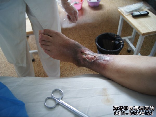 骨髓炎患者的伤口部位