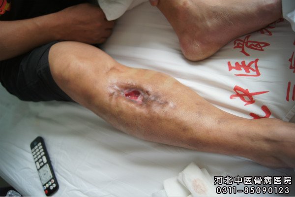 骨髓炎患者的伤口部位