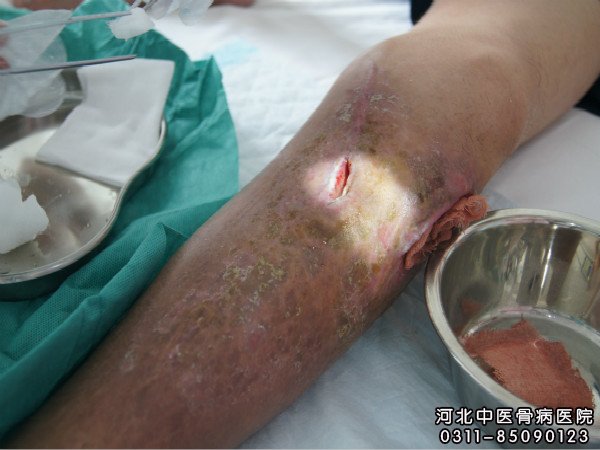 骨髓炎患者的伤口部位