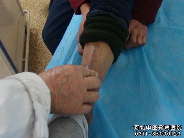 我院大夫为骨髓炎患者查看伤口部位