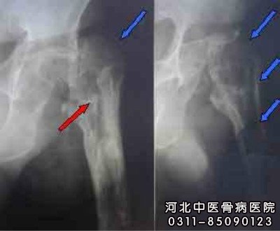 骨髓炎X片