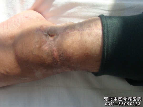 骨髓炎