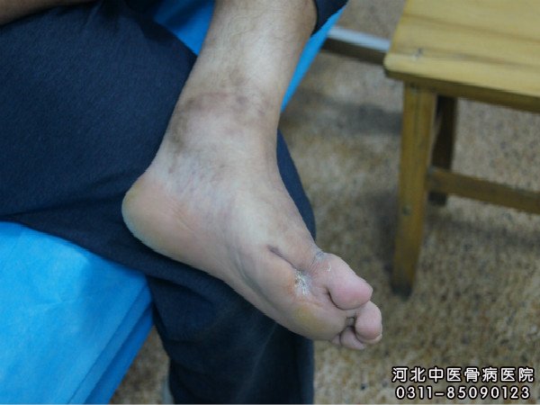 骨髓炎患者的伤口