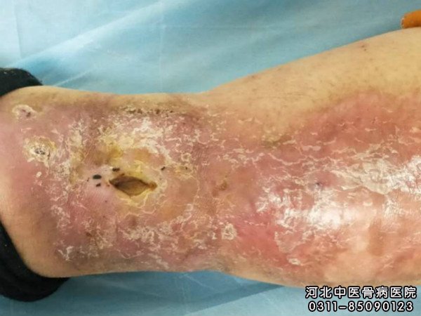 骨髓炎患者的伤口部位