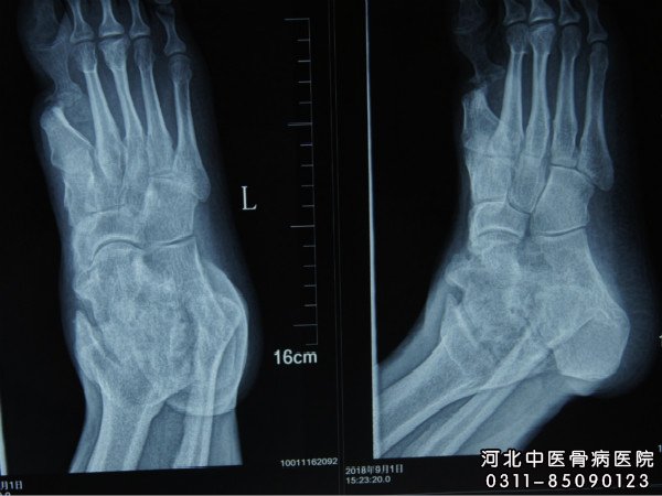 骨髓炎X片