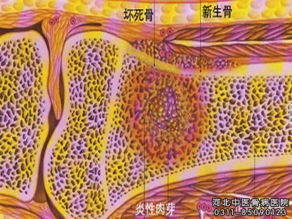 骨髓炎病因