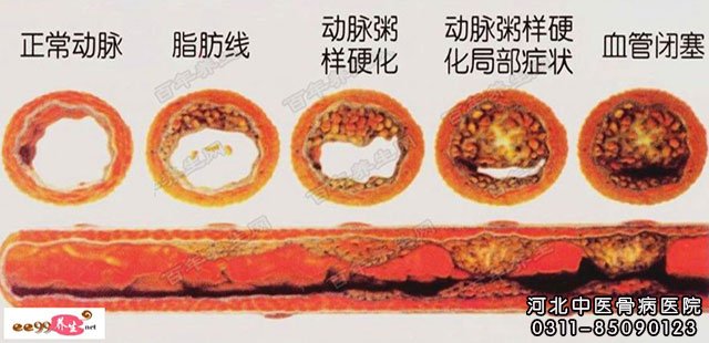 脑动脉粥样硬化
