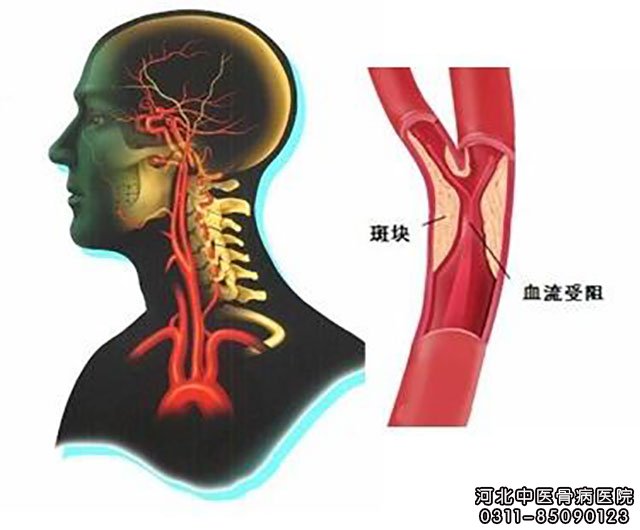 脑动脉粥样硬化