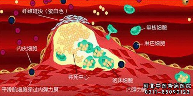 脑动脉粥样硬化