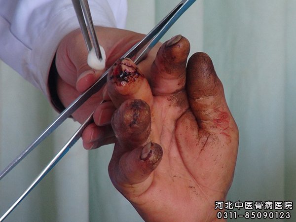 指骨骨髓炎