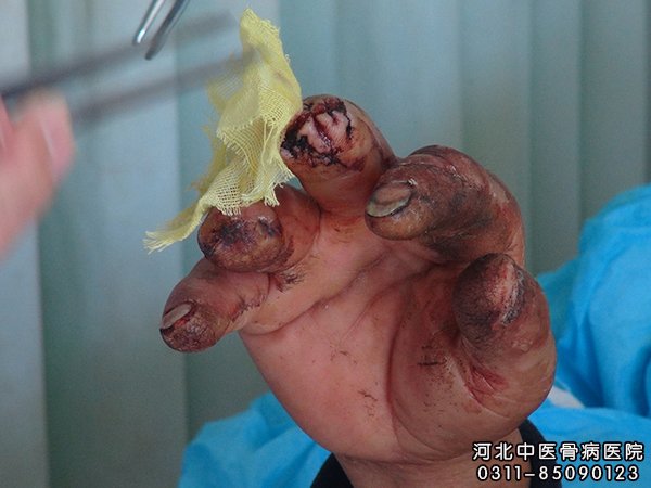 手指骨髓炎