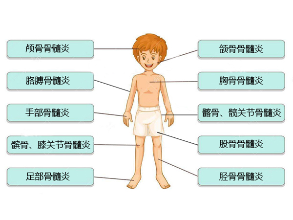 儿童骨髓炎