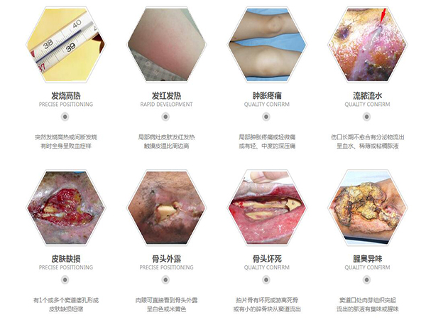 骨髓炎的症状表现