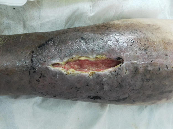 骨髓炎