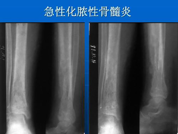 化脓性骨髓炎