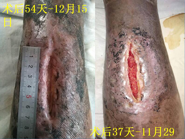 外伤性骨髓炎