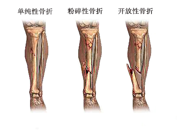 骨折性骨髓炎