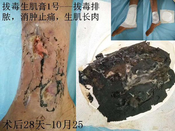 骨髓炎治疗方法