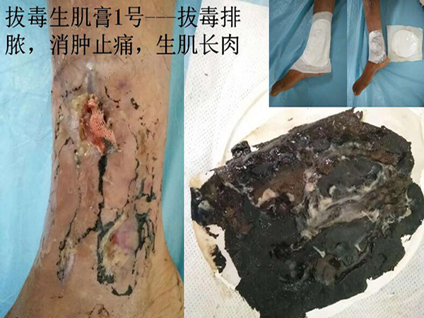 慢性骨髓炎