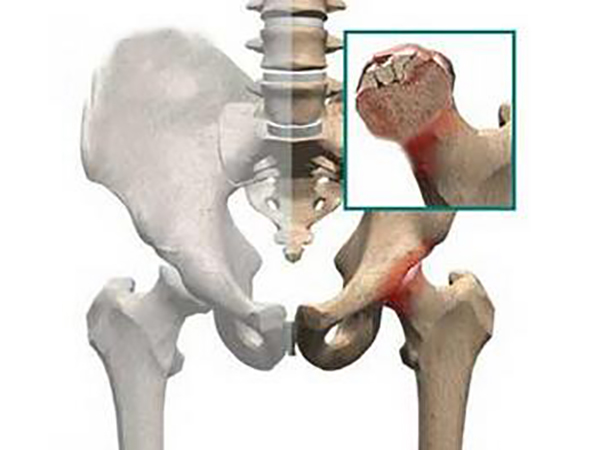 股骨头坏死疼痛