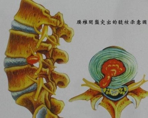 腰间盘突出